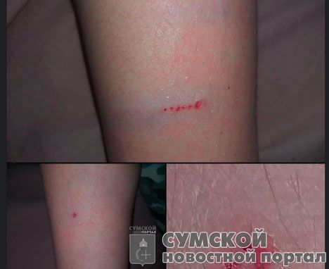 sumy-novosti-ukus-sobaki